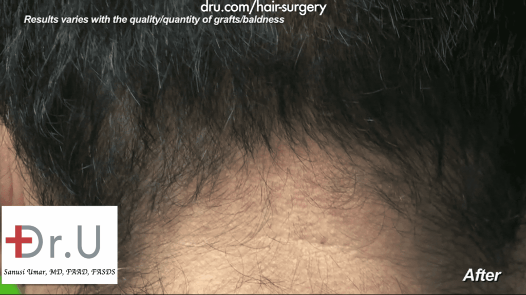 Hairline transplant: The nape of the patient has healed properly while growing back and showing no visible sign of the 1000 Dr.UGraft repair of hairline after previous strip surgery performed by Dr. Umar
