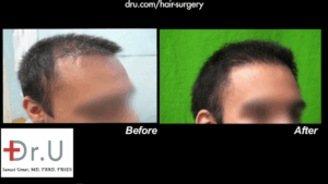A side angle of this patients new and more natural looking hairline and temple region thanks to Dr. U.