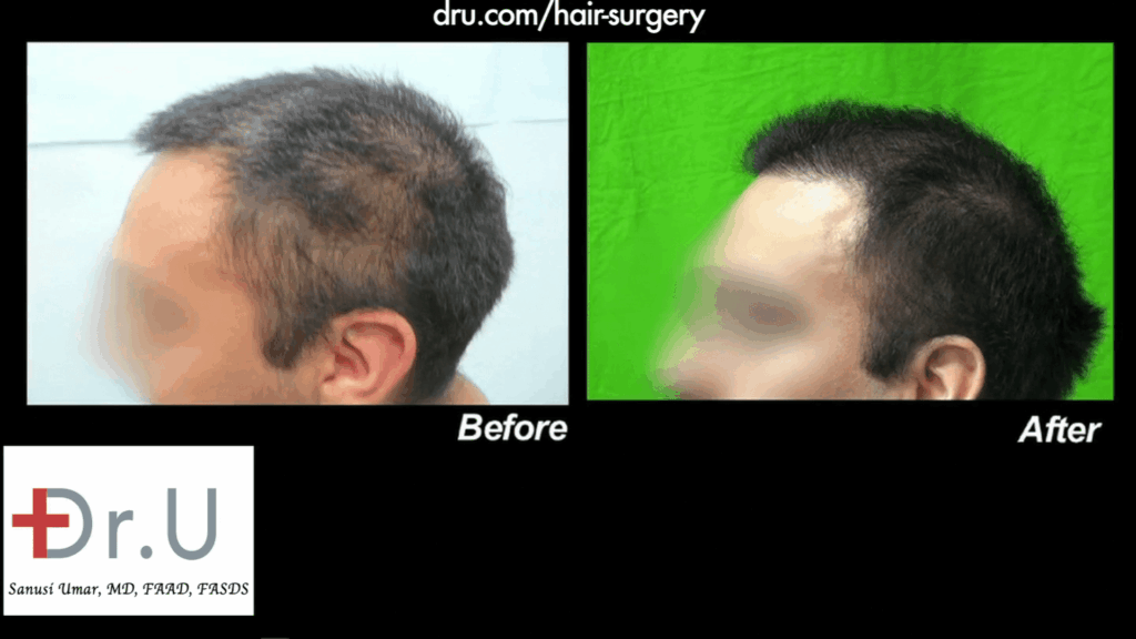 Hairline Repair Using Nape hair - Frontal Hair Transplant Before and After Photo
