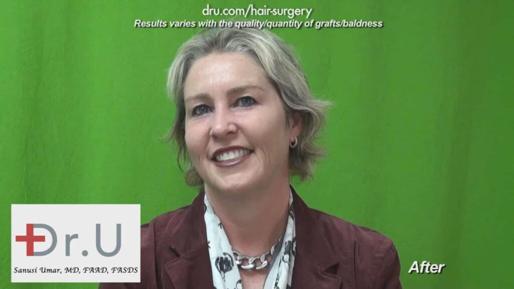 Dr UGraft Surgery For Eyebrow Hair Loss Treatment Achieves Brook Shields Eyebrow Look Dr UGraft Surgery For Eyebrow Hair Loss Treatment Achieves Brook Shields Eyebrow Look