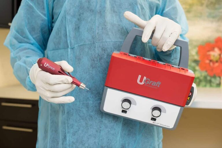 The Dr.UPunch Rotor ™ is an advanced FUE device that can be used in a multitude of hair transplant surgeries, including the patient's lash enhancement procedure.