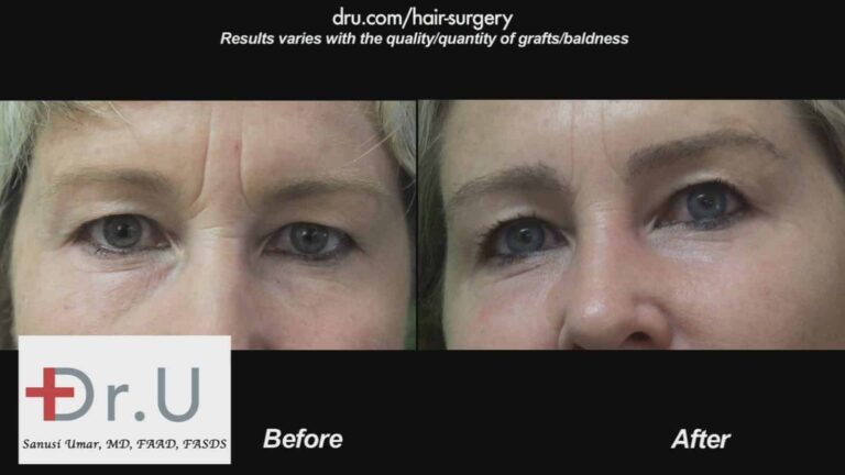 Help for thinning eyebrows: The Dr.UGraft offer's Eyebrow loss solutions Help for thinning eyebrows: The Dr.UGraft offer's Eyebrow loss solutions