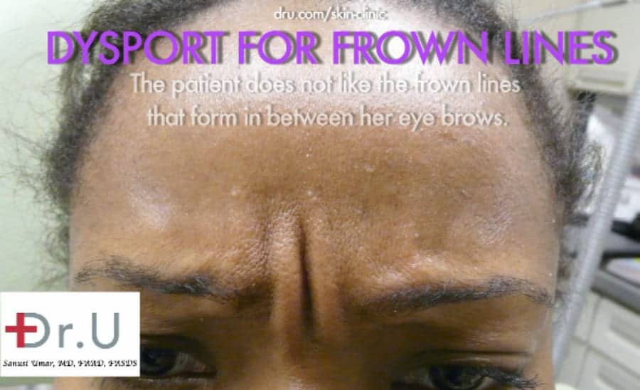 Dysport Used in Treatment of Frown Lines