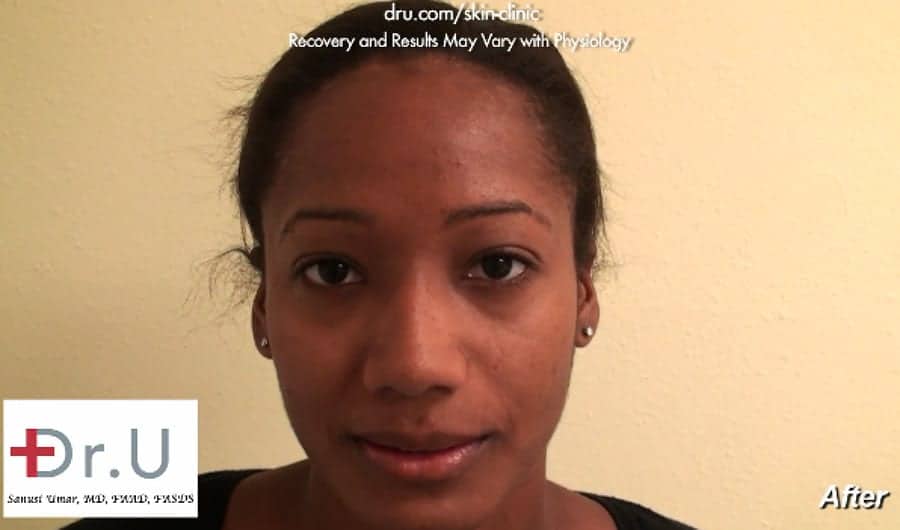 Dysport Used in Treatment of Frown Lines