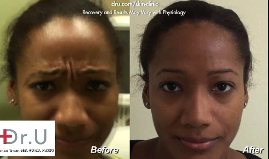 Dysport Before and After - Treatment of Frown Lines