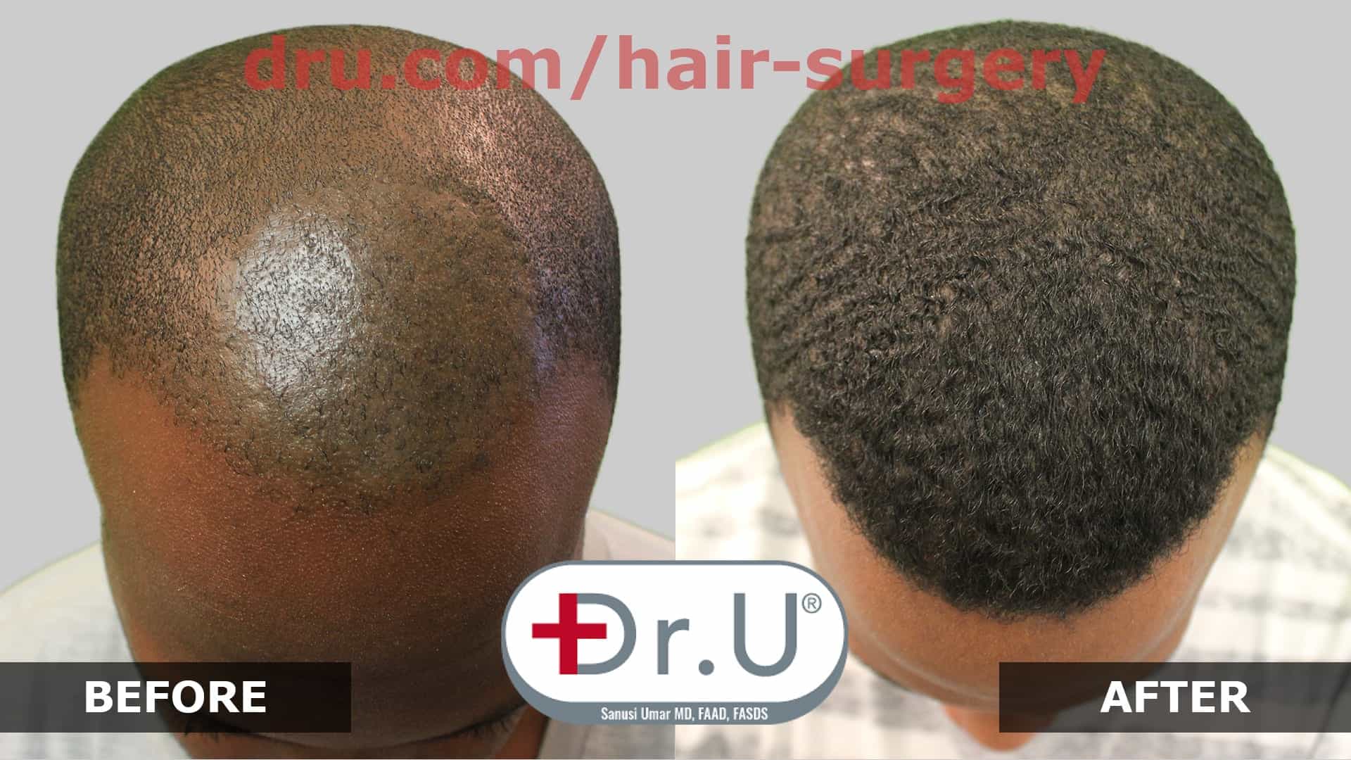 This patient had scarring in the front of his head from a childhood condition. Dr. Umar and his patented DrUPunch Curl gave this patient the hairline he always wanted.*