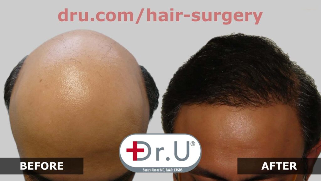 Dr. U helped this patient at the Norwood 7 scale stage reverse his severe baldness using 12,000 head and beard hair grafts Dr. U helped this patient at the Norwood 7 scale stage reverse his severe baldness using 12,000 head and beard hair grafts