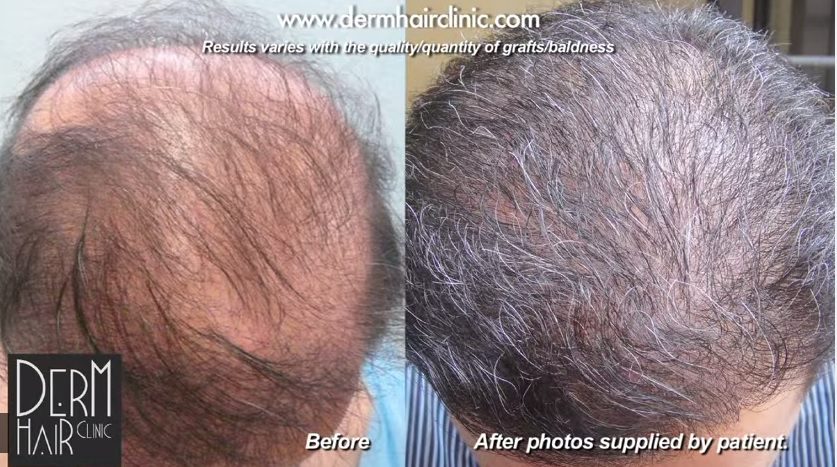 The best hair restoration clinic in the world can also repair prior, non-permanent hair transplant procedures A patient with prior hair transplant procedures turned to the best FUE hair transplant clinic in the world for repair