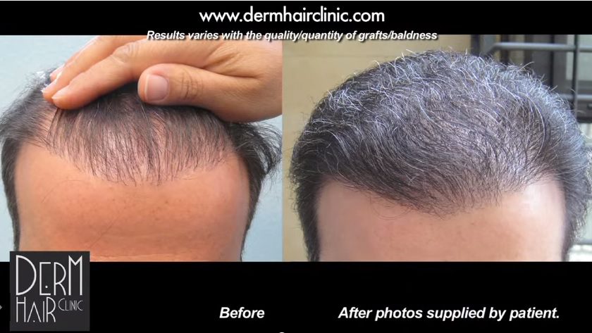 The best FUE hair transplant clinic in the world can create fuller, more natural hairlines Every angle of a patient's hair restoration can look natural once again with the DrUGraft method and the best hair restoration clinic in the world
