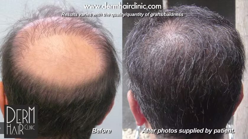 The best FUE hair transplant clinic in the world can solve areas of baldness with fuller, more natural hair restoration A successful hair restoration, and the best hair restoration clinic in the world, can repair severe baldness or the effects of previous procedures