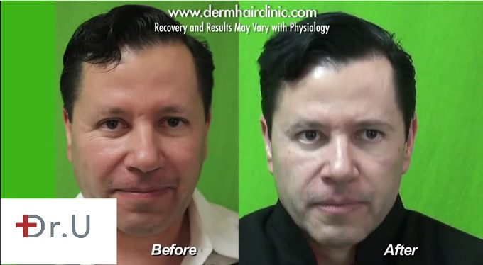 The best hair transplant clinic in the world can restore natural hairlines and fullness This patient's hairline is fuller after the DrUGraft procedure at the best hair restoration clinic in the world