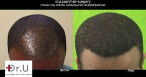 VIDEO: Dr UPunch CURL for Successful African Hair Follicular Unit Extraction - Thumbnail