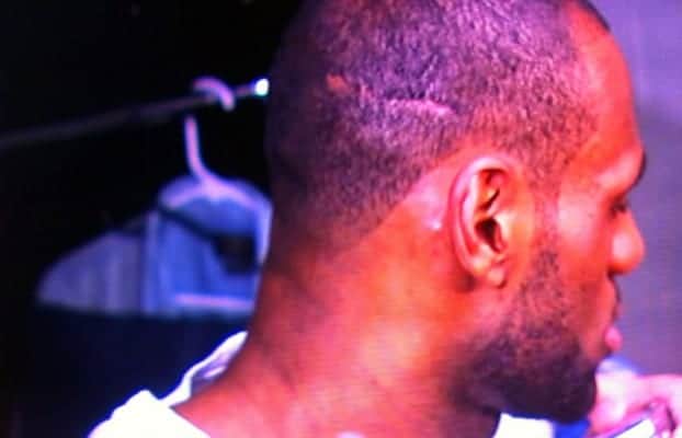 Lebron James and what appears to be a bad hair transplant strip scar.