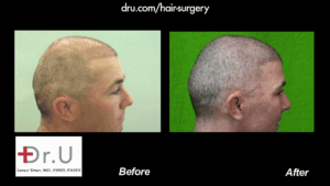 NW6 Baldness corrected with 13,500 Grafts