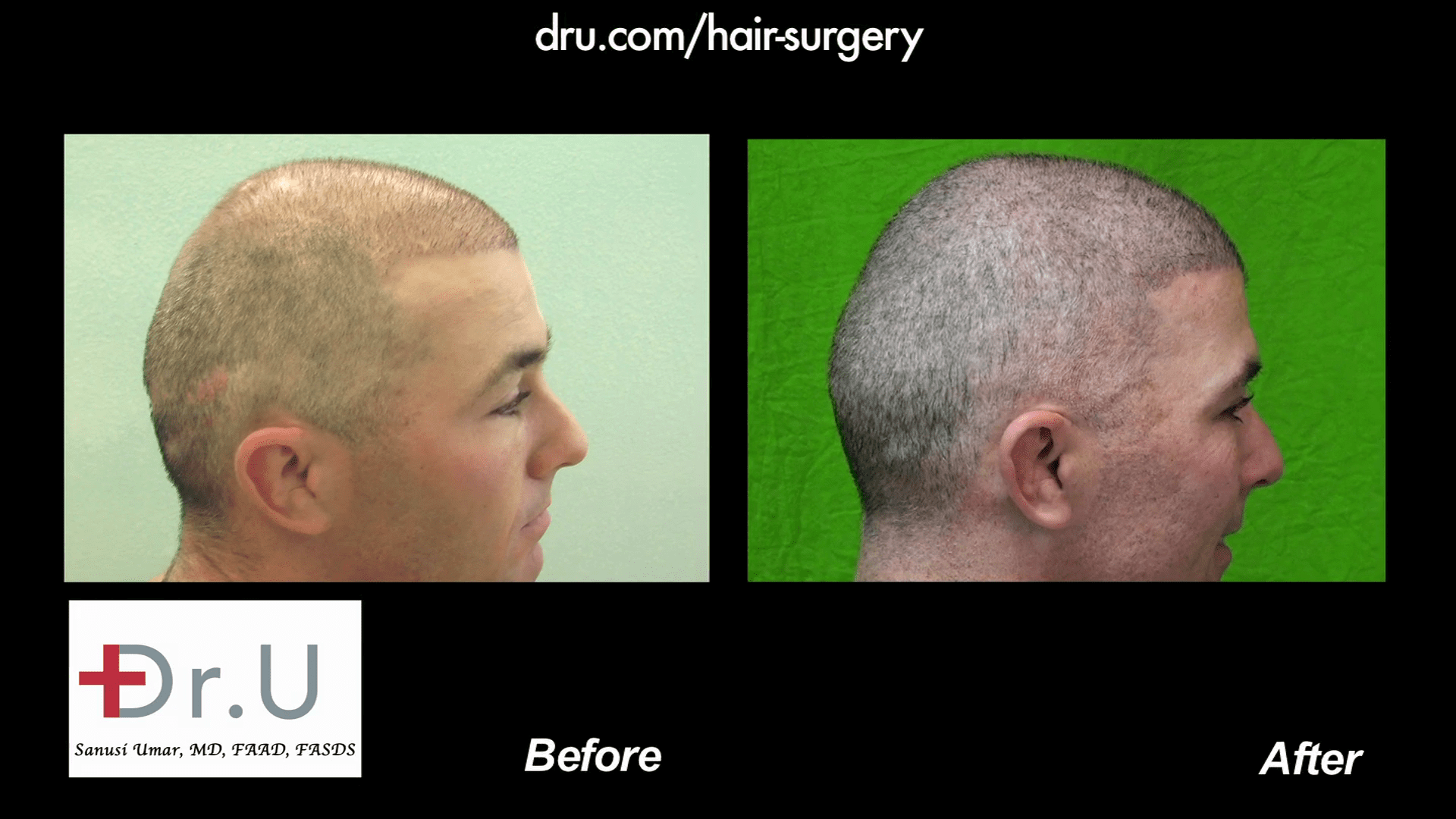 NW6 Baldness corrected with 13,500 Grafts