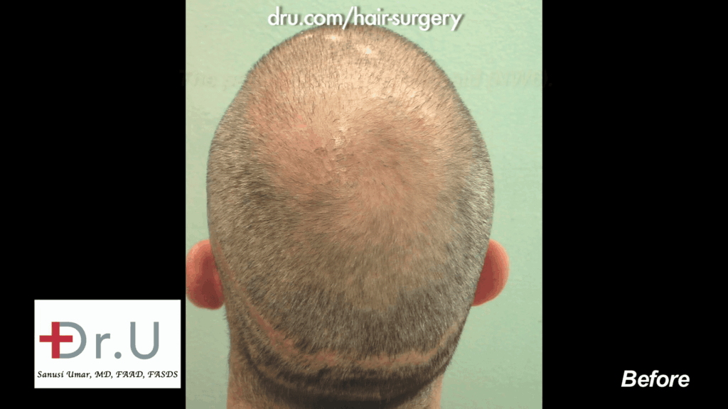 NW6 Baldness prior to being corrected with 13,500 Grafts
