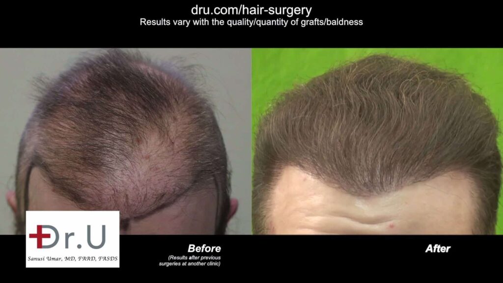 Best Corrective Hair Surgery Doctor in the World: Dr. Umar restored this patient's hairline and repaired scarring from a previous procedure