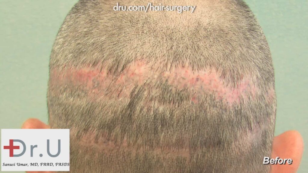 This closeup photo of a Dr. U patient before his body hair transplant procedure.