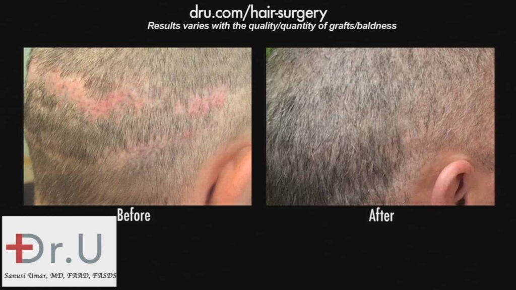 Strip scar repair using only beard hair grafts: A close-up of Dr. U's results when covering this patient's scars.*