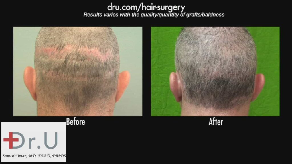 An example of a botched hair surgery successfully restored by Dr. U using the Dr.UGraft™ system.*