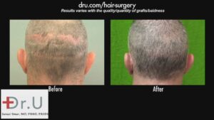 Before and after photos of a patient of Dr. Uma who had significant scarring on the back of his head.