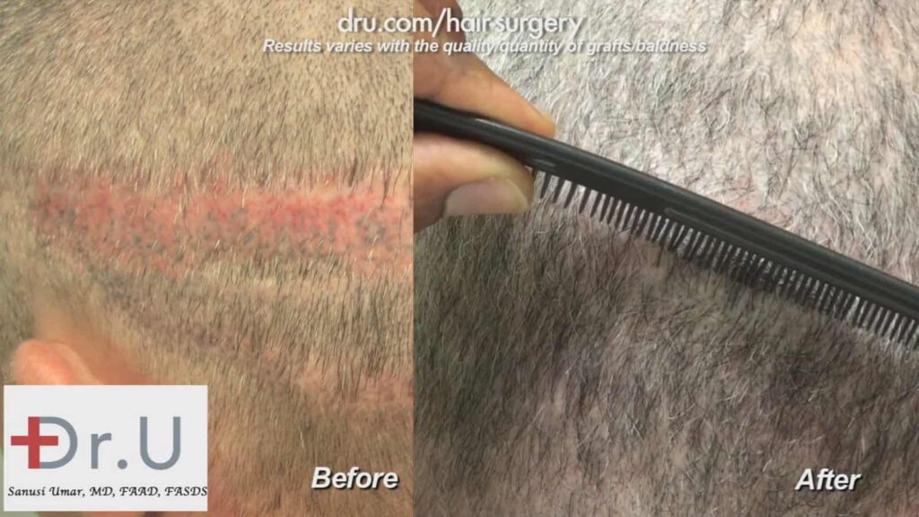 FUE hair transplant from beard: Hair transplant scar revision before and after