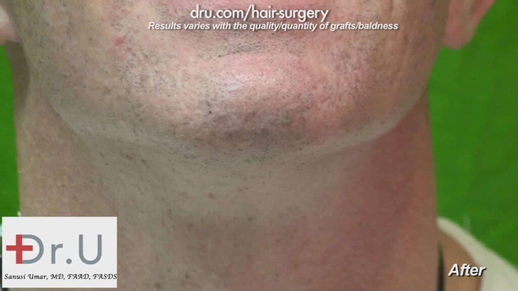 Beard donor area after FUE wound healing
