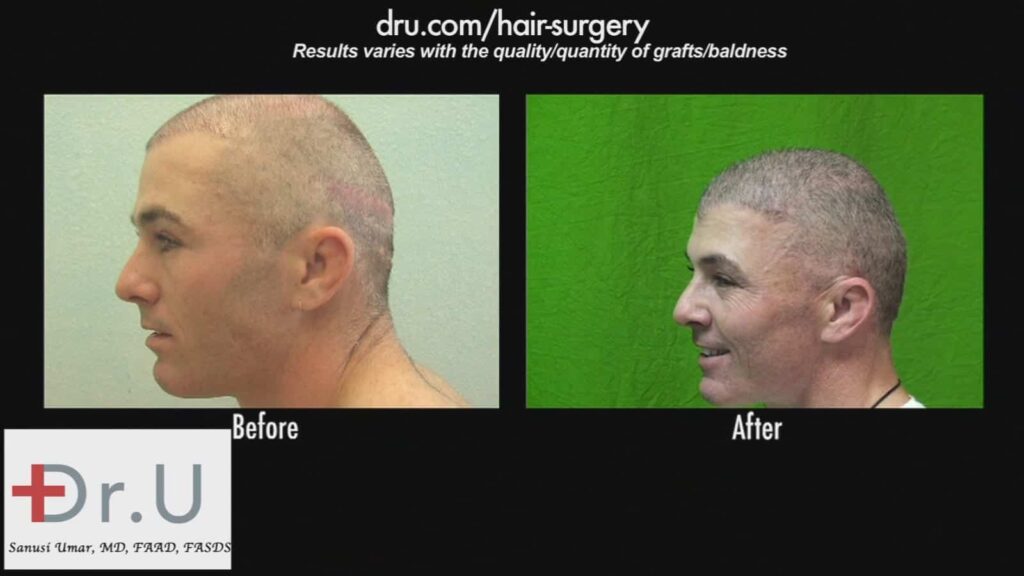 Hair transplant scar cover up using FUE using beard hair