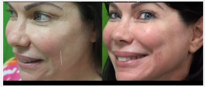 Belotero Dermal Filler Before and After Belotero Dermal Filler Before and After
