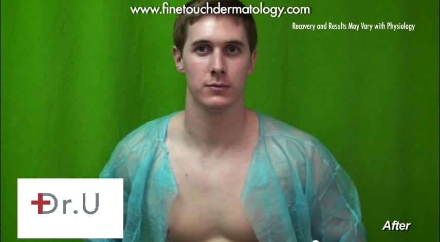 What can I do for rosacea? V Beam laser is the best treatment for rosacea.