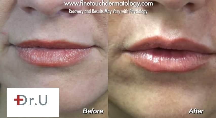 Hyaluronic Acid Dermal Fillers particularly Juvederm used to augment lips by Dr U in his Los Angeles patient. Before and after photo shows very natural outcome Hyaluronic Acid Dermal Fillers particularly Juvederm used to augment lips by Dr U in his Los Angeles patient. Before and after photo shows very natural outcome for fuller lips