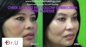 The patient before and after Dr. U performed a non surgical cheek lift using Radiesse.*