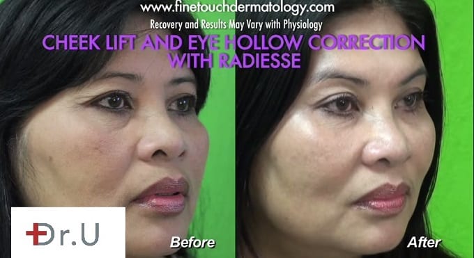 Non surgical cheek augmentation with fillers lift restores midface volume Non surgical cheek augmentation with fillers lift restores midface volume