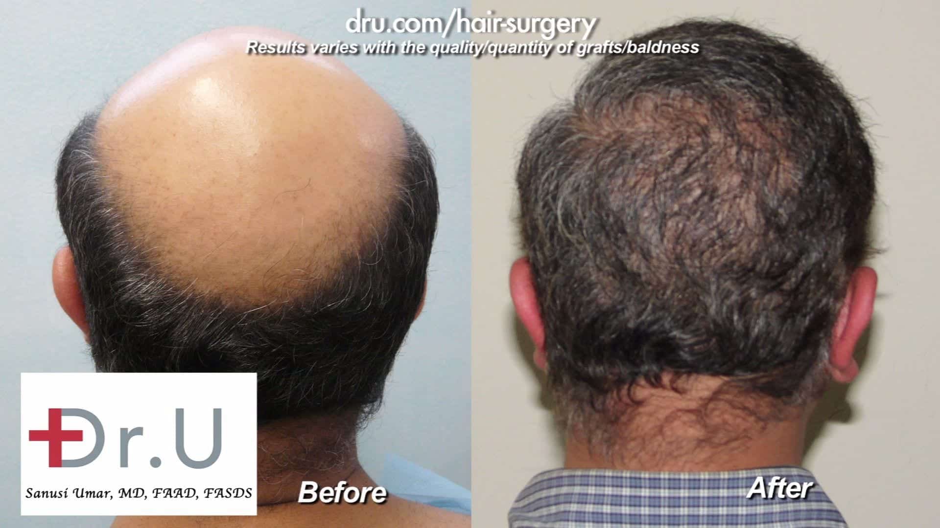 Board certified hair restoration surgeon - specialist in body hair transplant for severe baldness