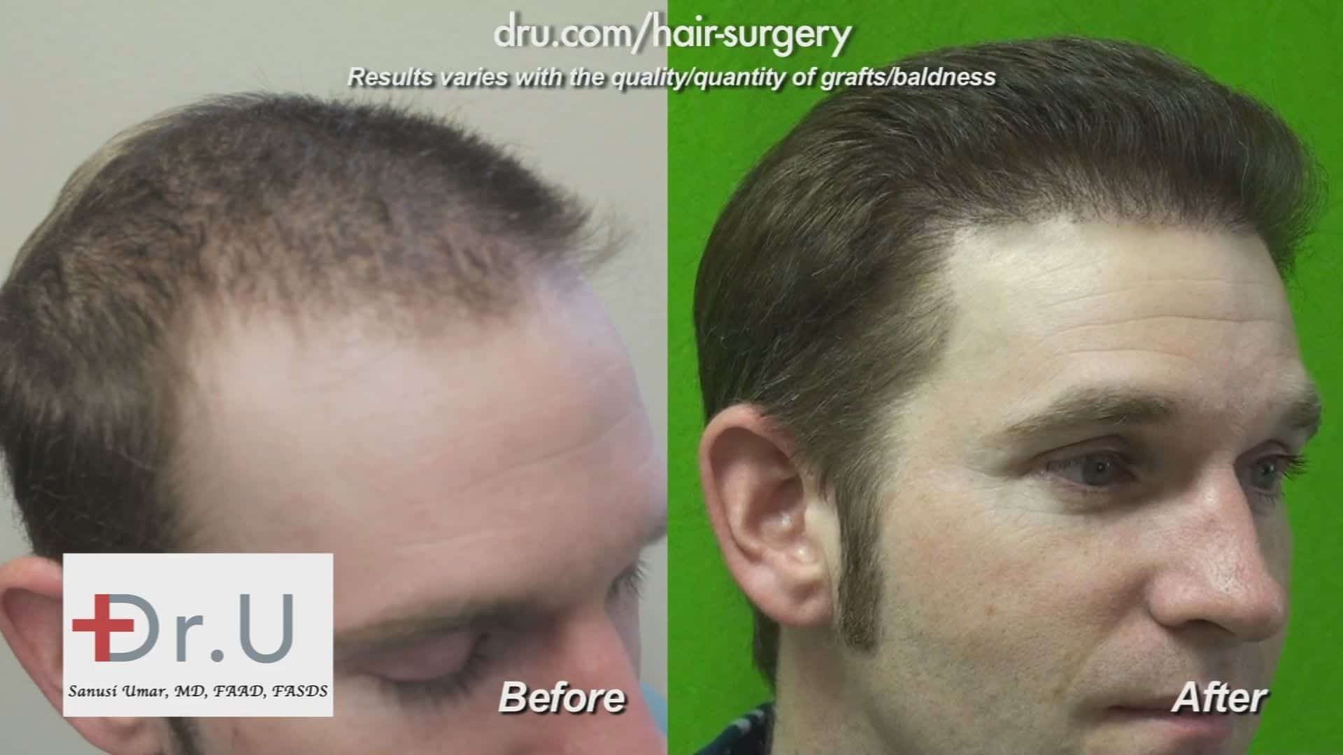 This patient benefited immensely from his FUT (Follicular Unit Transfer) surgery, which is also known as Follicular Unit Extraction, although no one would have guessed that he had a hair transplant * 