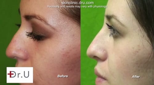 Before and after Radiesse Dermal Filler Treatment for the nose.
