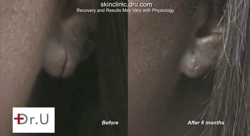 Torn ear corrected through ear split repair in Los Angeles. Torn ear corrected through ear split repair in Los Angeles.