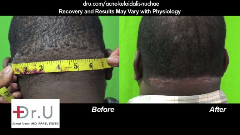 Large Acne Keloidalis Nuchae bumps, like the example shown here, can be surgically excised using Dr.U's bat excision technique which results in a straight, linear scar that is aligned with the posterior hairline Dr U AKN Surgical Excision of Lesion Treatment Results