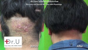 Dr Umar AKN Back of Neck Razor Bumps Removal Surgery Results