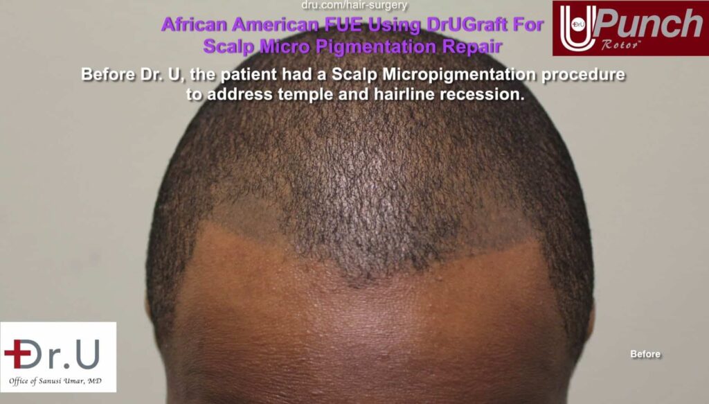 Dr. Umar was present with a patient who wanted to fill in his hairline after getting a poorly done tattoo.