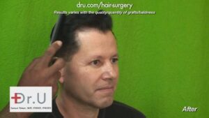 Result photo of a patient who had his hairline reshaped and lowered by Dr. Umar and his DrUGraft technology in Los Angeles.