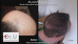 The results of this Norwood 7 patient who received a hair transplant by Dr. U in Los Angeles.