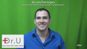 This patient is very happy with his hair transplant surgery results by Dr. Umar in Los Angeles.