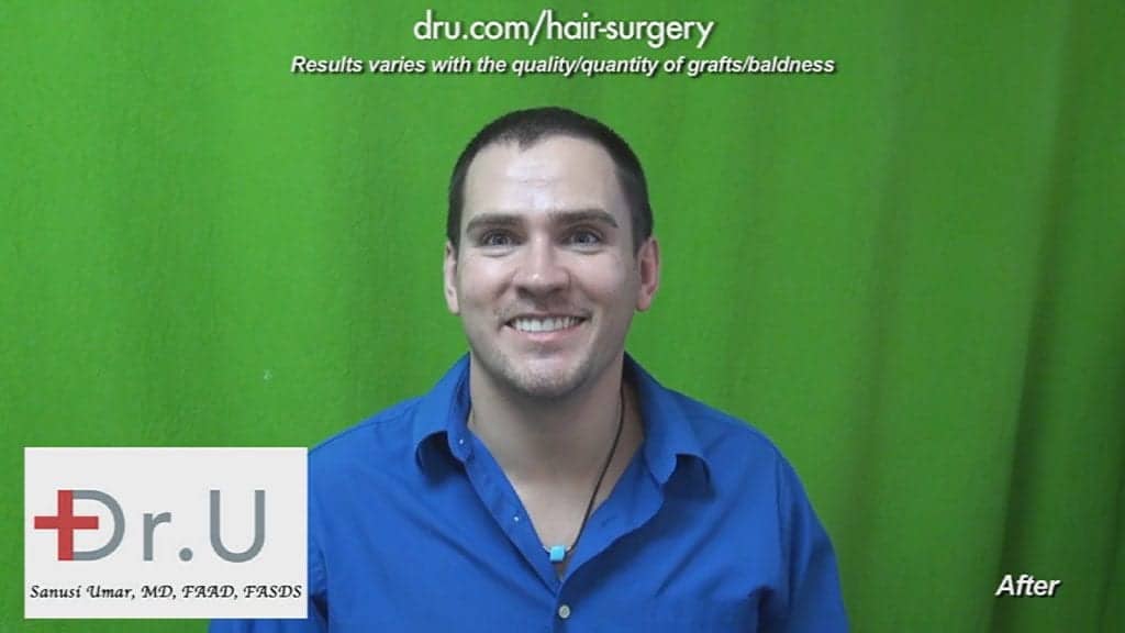 This patient is very happy with his hair transplant surgery results by Dr. Umar in Los Angeles.