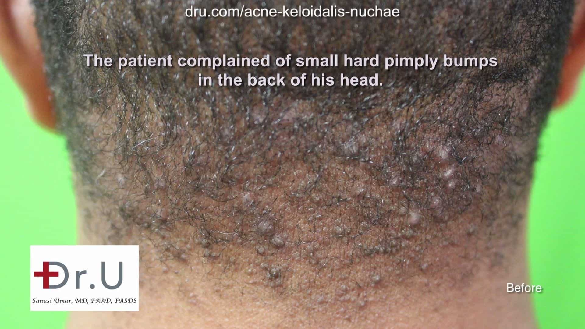 Non surgical treatment of acne keloidalis nuchae is possible at this early stage in which the papules are small and dispersed.