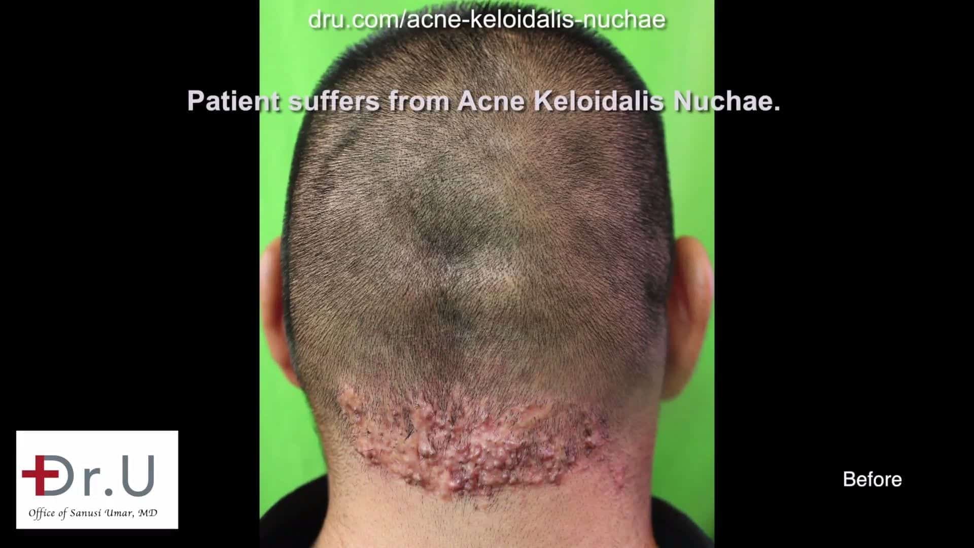 "What is the cost of AKN surgery?” didn’t stop this patient from reclaiming his life through AKN removal surgery at Dr. U Skin Clinic.*