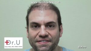 A before photo of a patient before his reparative hair transplant surgery from Dr. Umar.
