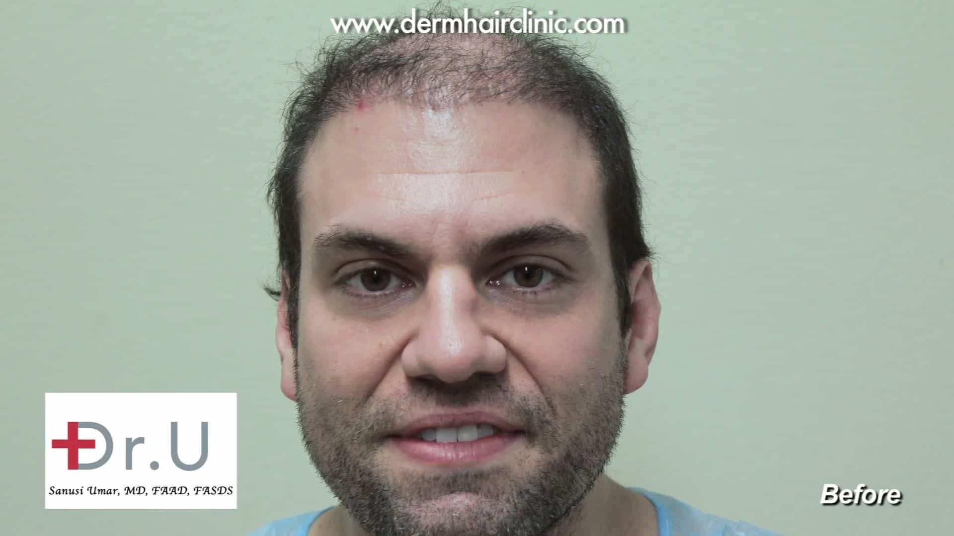 A before photo of a patient before his reparative hair transplant surgery from Dr. Umar.