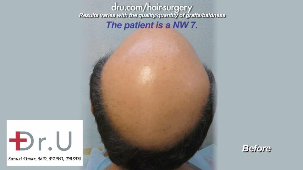 An example of a severely bald patient with level 7 baldness before crown restoration by Dr U showing severe hair loss at the crown. Conventional FUSS and FUT had written him off. 