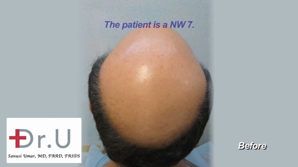 Impact of graft count of price of hair surgery :This Dr U patient was a category 7 on the Norwood Scale. He needed at least 12000 grafts for a credible hair restoration